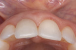 Fig 20. Incisal view at 6-year follow-up showed well-maintained facial gingival profile.