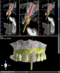 Fig 3. Digital planning of implant position.