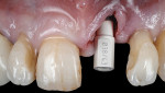Fig 6. Intraoral scan for fabrication of provisional restoration.