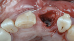 Fig 8. Bone graft wedged and compacted into socket.