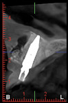 Fig 10. CBCT of implant position.