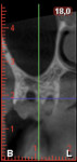 Fig 15. Tuberosity immediately after the graft segment was removed.