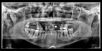 Fig 3. Panoramic radiograph at initial presentation demonstrating terminal dentition of the maxillary teeth.