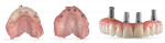 Fig 6. Extraoral reverse scan technique: (left) the STL file of the conversion prosthesis providing the tooth position; (center) the edentulous maxillary scan providing the healed residual ridge contours; (right) the conversion prosthesis with the reverse scan bodies providing the implant positions.