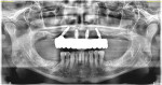 Fig 12. Postoperative panoramic radiograph confirming proper fit of prosthesis.