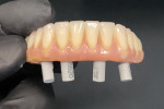 Fig 15. Reverse scan bodies connected to the passively fitting conversion prosthesis, to be digitally scanned in the extraoral reverse scan technique.