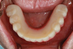 Fig 16. Occlusal view of final mandibular screw-retained prosthesis.