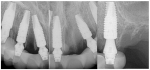 Fig 22. Postoperative periapical x-rays on the day of surgery demonstrating the provisional restoration with ti-bases fully seated to multi-unit abutments and ideal immediate implant placement.