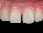 (1.) Pretreatment close-up view of a midline diastema that the patient was concerned about and requested be closed.