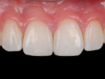 (2.) Close-up, 1-year postoperative view of the final result of the diastema closure with a single-shade composite.