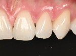 (3.) Pretreatment close-up view of a black triangle between teeth Nos. 9 and 10 that the patient was unhappy about.