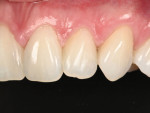(4.) Immediate postoperative close-up view of the result of black triangle treatment using a single-shade composite.