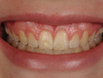 (5.) Pretreatment smile photograph of a patient who was unhappy about the appearance of her smile, particularly the loss of tooth structure on the facial surfaces of her central incisors. Tooth whitening was performed before any restorative work.