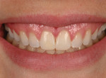 (6.) Immediate postoperative smile view after thin direct composite veneers were placed with a single-shade composite.