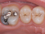 (7.) Occlusal view of recurrent decay under a failing amalgam restoration on a first molar.