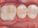 (8.) Immediate postoperative close-up view following amalgam removal and restoration with a single-shade composite.