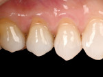 (9.) Pretreatment close-up view of abfraction lesions on the upper premolars, which were making the patient unhappy because they were collecting food.