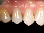 (10.) Immediate postoperative close-up view following the delivery of Class V restorations with a single-shade composite.