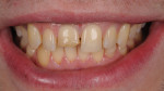 (11.) Smile view of a fractured maxillary central incisor restoration that required re-treatment.