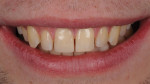 (12.) Immediate postoperative smile view of the final restoration, in which a blocker material was incorporated to improve shade matching and block the darkness of the mouth before a single-shade composite was used to complete it.