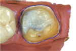 (3.) Virtual model of the digital scan of the same crown preparation for tooth No. 18.