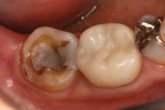 (1.) Example of a clinically challenging second molar that has a limited vertical dimension for the restoration.