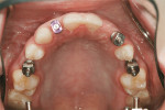 Figure 27  Open-tray impression copings in place. Note excellent implant positions.