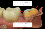 (4.) Example of the virtual model demonstrating a nonretentive, short tooth preparation for tooth No. 18 with an overtapered distal margin and short preparation wall height.