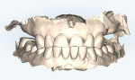 Fig 2. The patient returned 1 month post-extraction of her premolars. Both arches and her bite were scanned using an iTero Element™ 5D Plus imaging system, as seen in this model view.