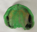 Fig 9. Final denture impression: border capture and wash impression. The monolithic PMMA denture was used as a final custom tray. A heavy-body impression material (Flexitime®, Kulzer) was used to capture the border. A light-body impression material (Flexitime) was syringed sparingly into the intaglio surface to finalize the functional impression process.