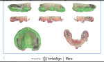 Fig 10. Final iTero intraoral scanner scans; this screenshot of scan information was sent to the lab to finalize the denture.
