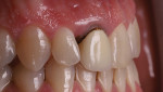 Fig 3. Intraoral images, including this lateral view, showed the maladaptive metal-ceramic crown. Darkening and inflammation of the gingival tissue was evident.