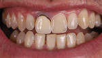 Fig 4. Tooth No. 9 was used as a digital guide to achieve proper design of No. 8.