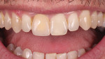 Fig 10. Clinical evaluation 1 week after seating the temporary acrylic crown.