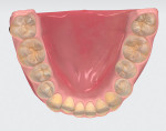 Fig 4. Initial scan (TRIOS 3, 3Shape) of the mandibular arch.