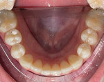 Fig 12. Post-orthodontic treatment, mandibular occlusal view, with crowding corrected and premolars moved buccally.