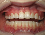 Fig 14. Post-orthodontic treatment, retracted open view, to demonstrate intruded mandibular anteriors and smoothed edges.