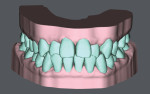 Fig 6. SureSmile simulated model pretreatment, frontal view.