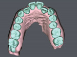 Fig 7. SureSmile simulated model pretreatment, occlusal view.