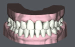 Fig 8. SureSmile simulated model post-treatment, frontal view.