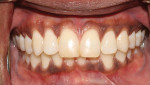 Fig 1. Preoperative, maximum intercuspation of the patient’s existing dentition at initial consultation.