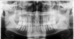Fig 2. Preoperative panoramic radiograph taken by the referring dentist a few months prior to the patient being seen in the author’s clinic.