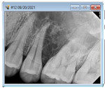Fig 3. Periapical radiograph from the referring dentist days before the patient was seen in the author’s clinic. Note the multilocular lesion between teeth Nos. 13 and 14.