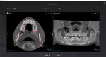 Fig 4. CBCT panoramic upper arch curved reconstruction using DTX Studio™ Clinic (DEXIS) software. On the right is the reconstructed panoramic image.