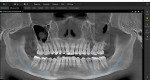 Fig 5. Panoramic upper arch curved reconstruction using DTX Studio Clinic (20 mm). Note severe opacification of the left maxillary sinus. The right maxillary sinus demonstrated a mucous retention pseudocyst, a radiographic finding with no clinical significance. Mandibular nerve tracing was done using the “Magic assistant” automatic feature on DTX Studio Clinic.