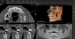 Fig 6. Panoramic reconstruction and cross-sectional views of the left maxilla in the area of the lesion (CBCT volume rendering and axial view).