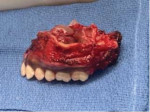 Fig 10. Surgical day. Resected part of the maxilla with safety margins and clearance from pathology is shown.