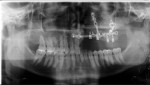 Fig 11. Post-resection panoramic radiograph. Note fixation of surgical plates with the fibula graft and dental implants (Paltop, Keystone Dental Group).