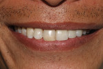 Fig 14. Close-up view of patient’s smile with final prosthesis inserted.