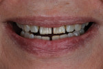 Fig 2. Initial smile photograph. The worn and chipped anterior teeth were indicative of poor function. Additionally, the patient was concerned about the diastemas between several teeth.